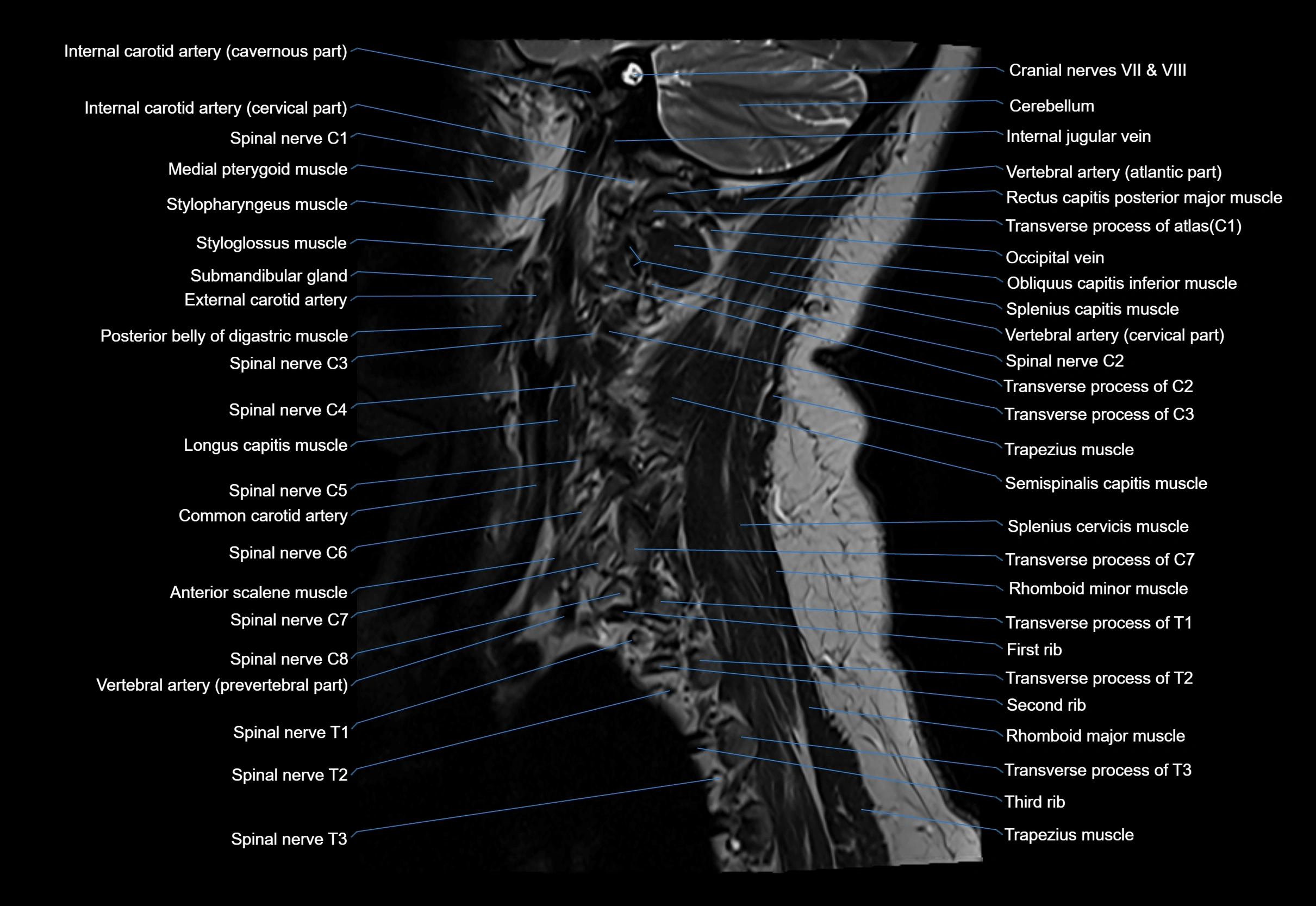 cervical spine cross sectional MRI anatomy 3T MRI  sagittal image-img-00001-00005.webp